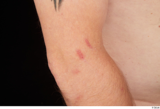 Louis arm scar 0001.jpg